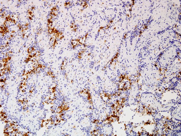 2C5 Papillary Glioneuronal Tumor (PGNT, Case 2) SYN 7.jpg