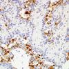 2C6 Papillary Glioneuronal Tumor (PGNT, Case 2) SYN 5.jpg