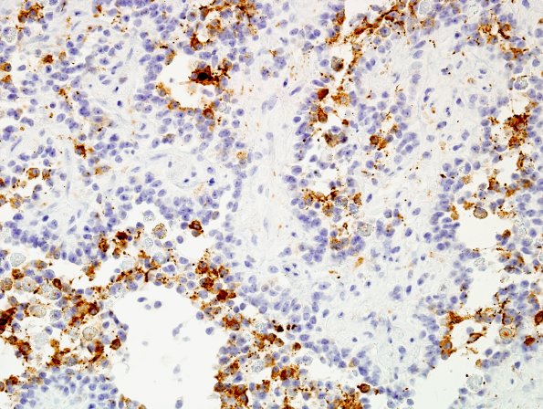 2C6 Papillary Glioneuronal Tumor (PGNT, Case 2) SYN 5.jpg