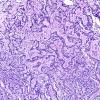 2E1 Papillary Glioneuronal Tumor (PGNT, Case 2) PAS 1.jpg