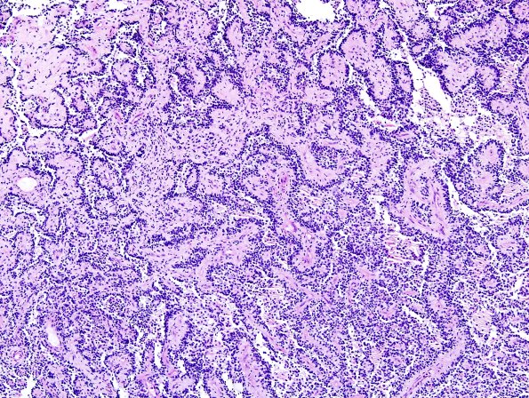 2E1 Papillary Glioneuronal Tumor (PGNT, Case 2) PAS 1.jpg