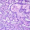 2E2 Papillary Glioneuronal Tumor (PGNT, Case 2) PAS 4.jpg