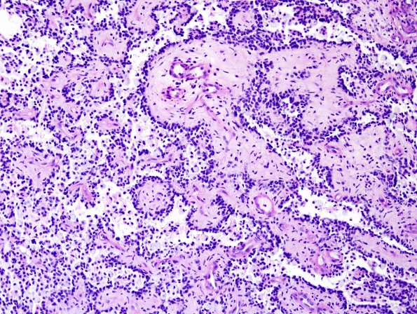 2E2 Papillary Glioneuronal Tumor (PGNT, Case 2) PAS 4.jpg