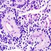 2E3 Papillary Glioneuronal Tumor (PGNT, Case 2) PAS 6.jpg