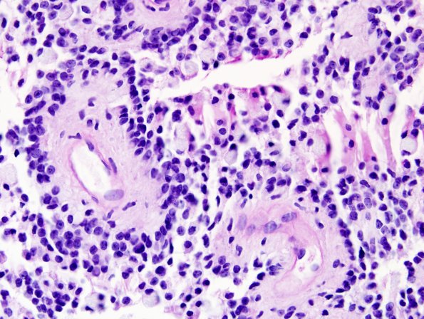 2E3 Papillary Glioneuronal Tumor (PGNT, Case 2) PAS 6.jpg