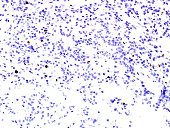 2F Papillary Glioneuronal Tumor (PGNT, Case 2) Ki67 1.jpg