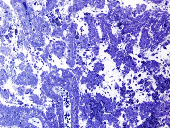 2G1 Papillary Glioneuronal Tumor (PGNT, Case 2) Plastic 4.jpg