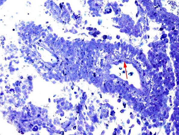 2G2 Papillary Glioneuronal Tumor (PGNT, Case 2) Plastic 2 copy.jpg