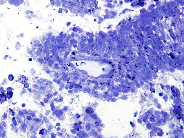 2G3 Papillary Glioneuronal Tumor (PGNT, Case 2) Plastic 3.jpg