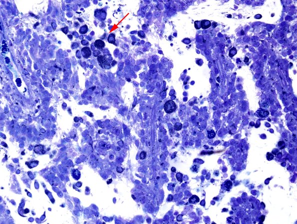 2G4 Papillary Glioneuronal Tumor (PGNT, Case 2) Plastic 1 copy.jpg