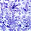 2G5 Papillary Glioneuronal Tumor (PGNT, Case 2) EM 8.jpg