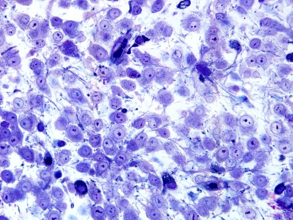 2G5 Papillary Glioneuronal Tumor (PGNT, Case 2) EM 8.jpg