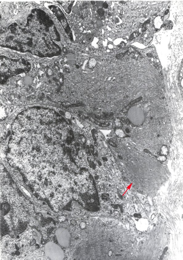 2H1 Papillary Glioneuronal Tumor (PGNT, Case 2) EM 1 copy - Copy