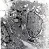 2H2 Papillary Glioneuronal Tumor (PGNT, Case 2 EM 2 - Copy