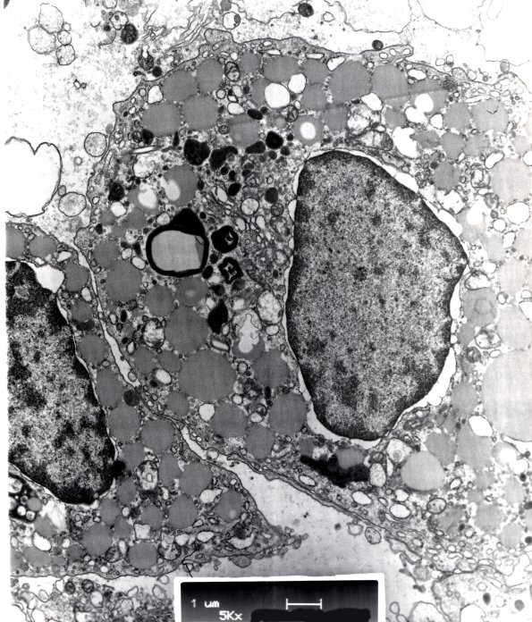 2H2 Papillary Glioneuronal Tumor (PGNT, Case 2 EM 2 - Copy