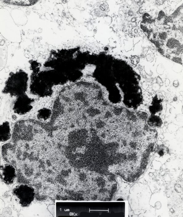 2H3 Papillary Glioneuronal Tumor (PGNT, Case 2) EM 3 - Copy