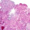 3A1 Papillary Glioneuronal Tumor (PGNT, Case 3) H&E 7.jpg