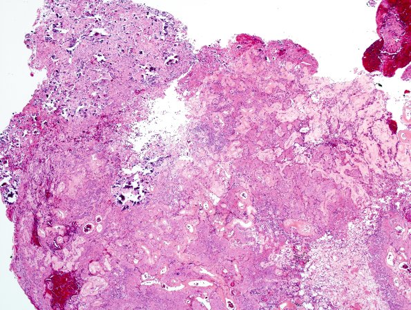 3A1 Papillary Glioneuronal Tumor (PGNT, Case 3) H&E 7.jpg