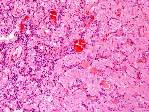 3A10 Papillary Glioneuronal Tumor (PGNT, Case 3) H&E 25.jpg