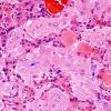 3A11 Papillary Glioneuronal Tumor (PGNT, Case 3) H&E 26 copy.jpg