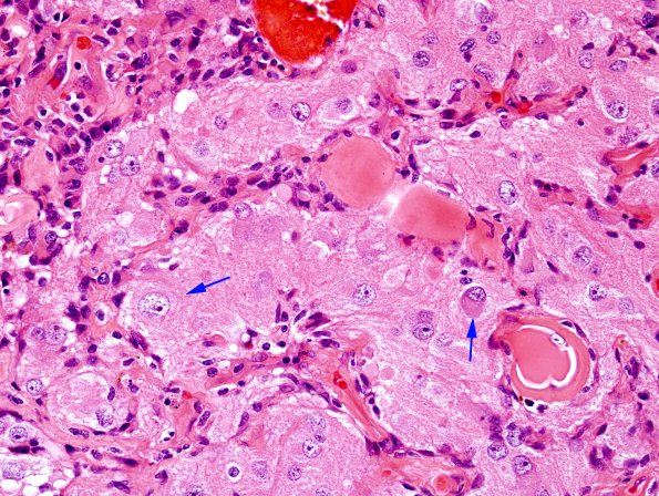 3A11 Papillary Glioneuronal Tumor (PGNT, Case 3) H&E 26 copy.jpg