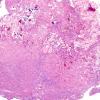 3A2 Papillary Glioneuronal Tumor (PGNT, Case 3) H&E 9.jpg