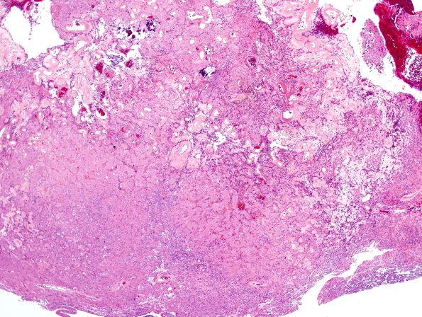 3A2 Papillary Glioneuronal Tumor (PGNT, Case 3) H&E 9.jpg