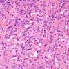 3A3 Papillary Glioneuronal Tumor (PGNT, Case 3) H&E 13.jpg