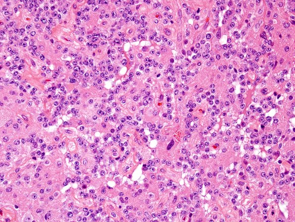 3A3 Papillary Glioneuronal Tumor (PGNT, Case 3) H&E 13.jpg