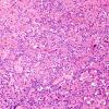 3A4 Papillary Glioneuronal Tumor (PGNT, Case 3) H&E 29.jpg