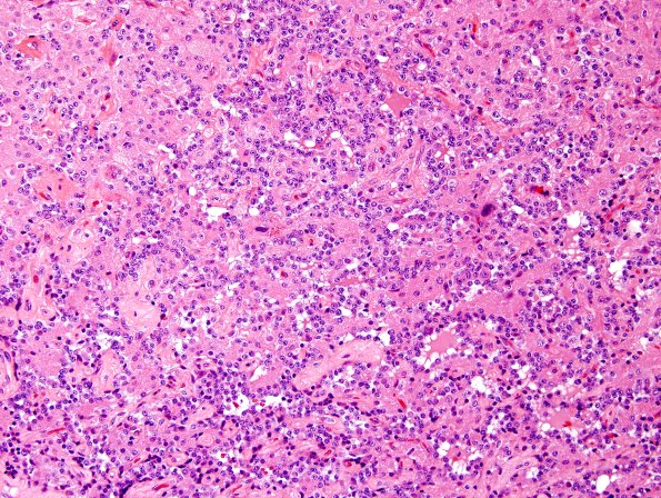 3A4 Papillary Glioneuronal Tumor (PGNT, Case 3) H&E 29.jpg