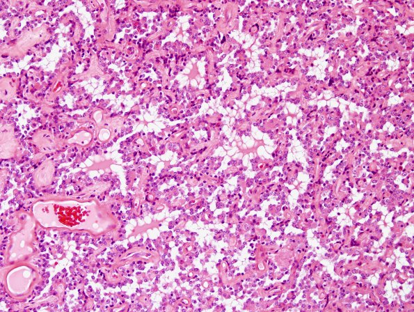 3A5 Papillary Glioneuronal Tumor (PGNT, Case 3) H&E 20.jpg