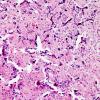 3A6 Papillary Glioneuronal Tumor (PGNT, Case 3) H&E 10.jpg