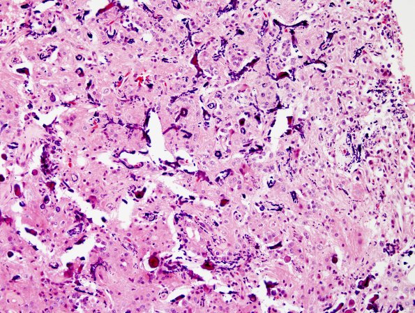 3A6 Papillary Glioneuronal Tumor (PGNT, Case 3) H&E 10.jpg