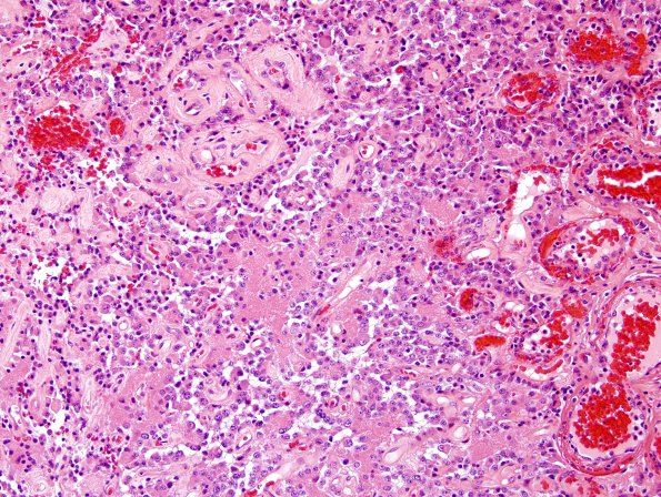 3A7 Papillary Glioneuronal Tumor (PGNT, Case 3) H&E 15.jpg