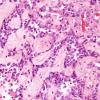 3A8 Papillary Glioneuronal Tumor (PGNT, Case 3) H&E 36.jpg