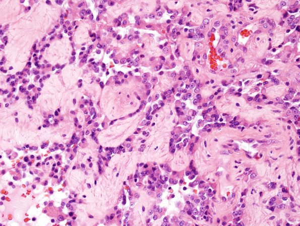 3A8 Papillary Glioneuronal Tumor (PGNT, Case 3) H&E 36.jpg