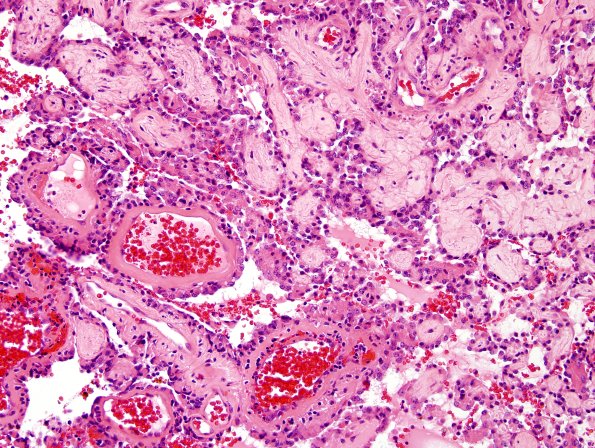 3A9 Papillary Glioneuronal Tumor (PGNT, Case 3) H&E 17.jpg