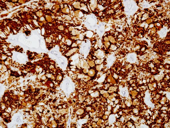 3B1 Papillary Glioneuronal Tumor (PGNT, Case 3) SYN 4.jpg