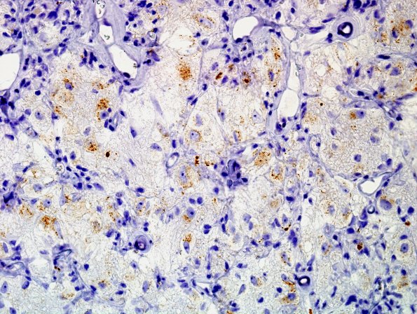 3C1 Papillary Glioneuronal Tumor (PGNT, Case 3) Chromogranin 6.jpg