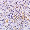 3C2 Papillary Glioneuronal Tumor (PGNT, Case 3) Chromogranin 5.jpg