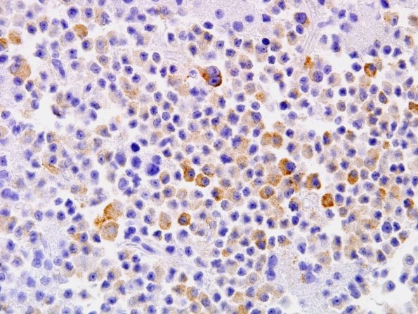 3C2 Papillary Glioneuronal Tumor (PGNT, Case 3) Chromogranin 5.jpg