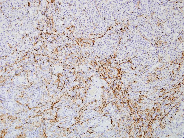 3E2 Papillary Glioneuronal Tumor (PGNT, Case 3) NF 3.jpg