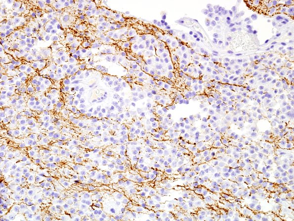 3E3 Papillary Glioneuronal Tumor (PGNT, Case 3) NF 10.jpg