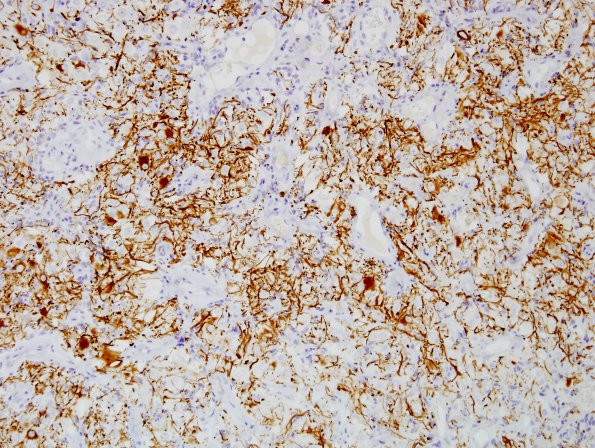 3E4 Papillary Glioneuronal Tumor (PGNT, Case 3) NF 6.jpg