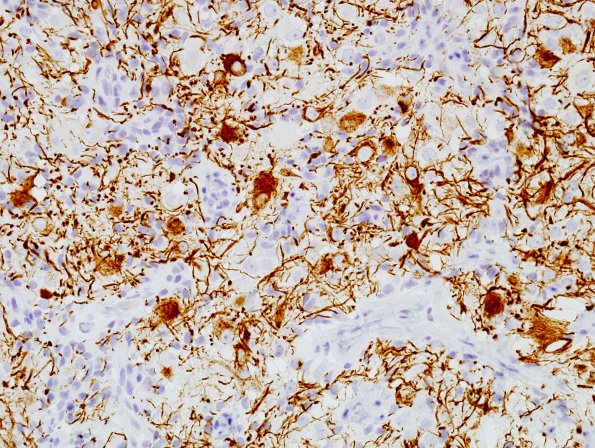 3E5 Papillary Glioneuronal Tumor (PGNT, Case 3) NF 7.jpg