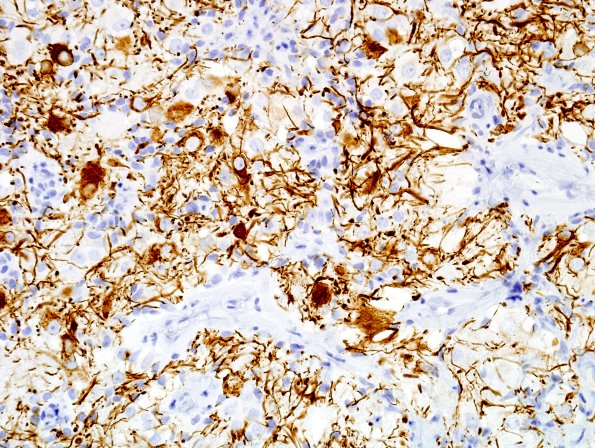 3E6 Papillary Glioneuronal Tumor (PGNT, Case 3) NF 13.jpg