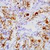 3E7 Papillary Glioneuronal Tumor (PGNT, Case 3) NF 8.jpg