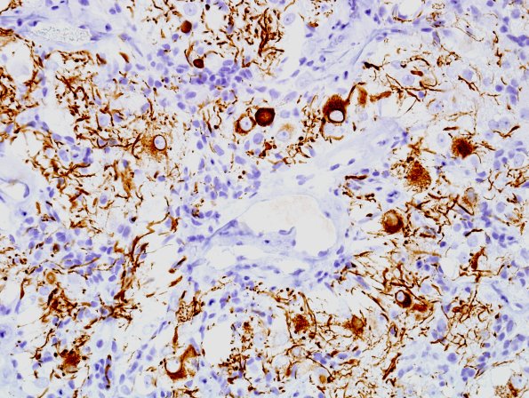 3E7 Papillary Glioneuronal Tumor (PGNT, Case 3) NF 8.jpg