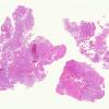 4A1 Papillary Glioneuronal Tumor (PGNT, Case 4) 1 H&E whole mount